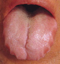 あなたの舌 ギザギザしてますか 危険ですよ 痛くならないための治療なら 五反田 大崎瀬戸歯科医院 白いメガネの歯医者さん