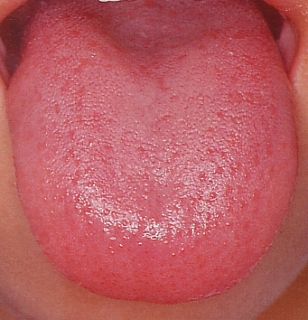 あなたの舌ひび割れていませんか 大丈夫ですか 痛くならないための治療なら 五反田 大崎瀬戸歯科医院 白いメガネの歯医者さん
